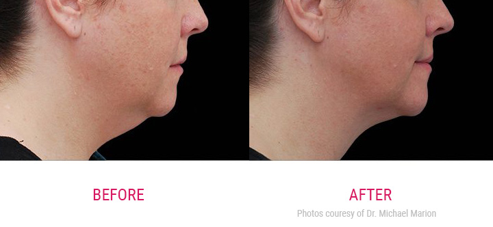 coolsculpting before and after