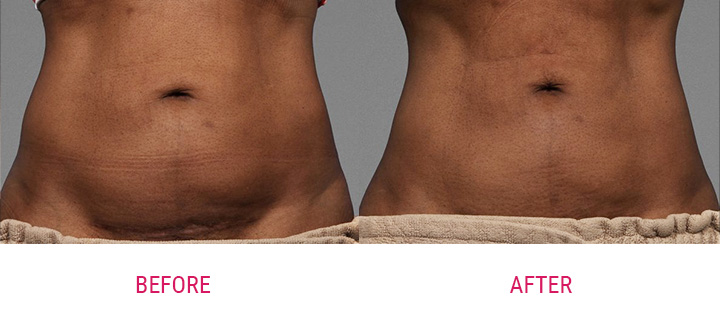 cooltone before and after