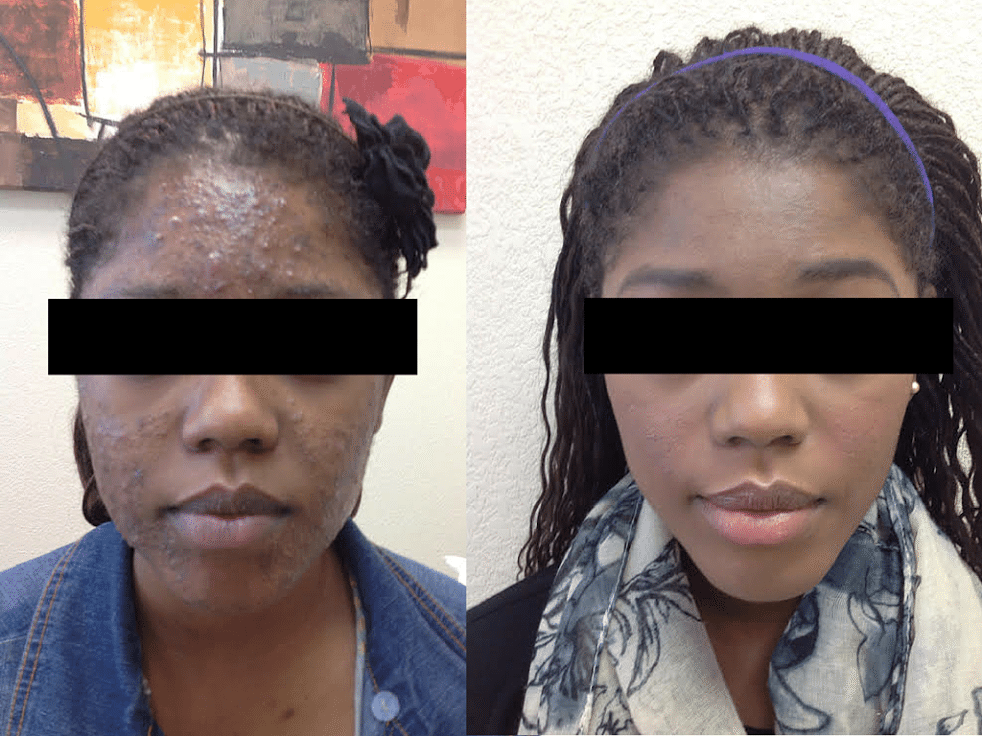 acne treatment before and after