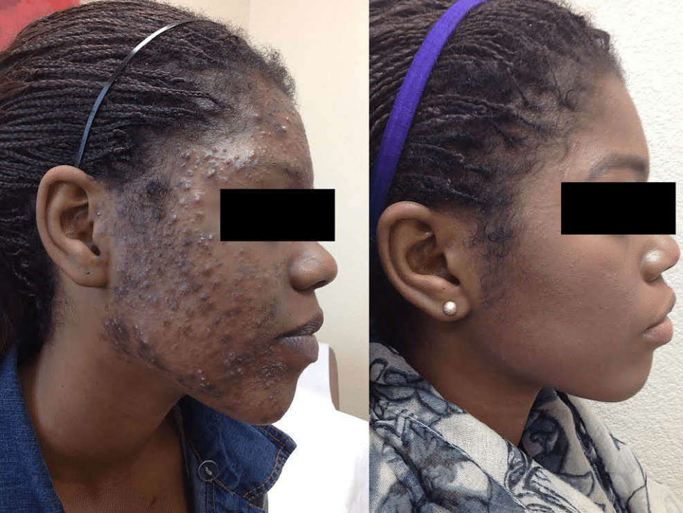 mild acne vulgaris