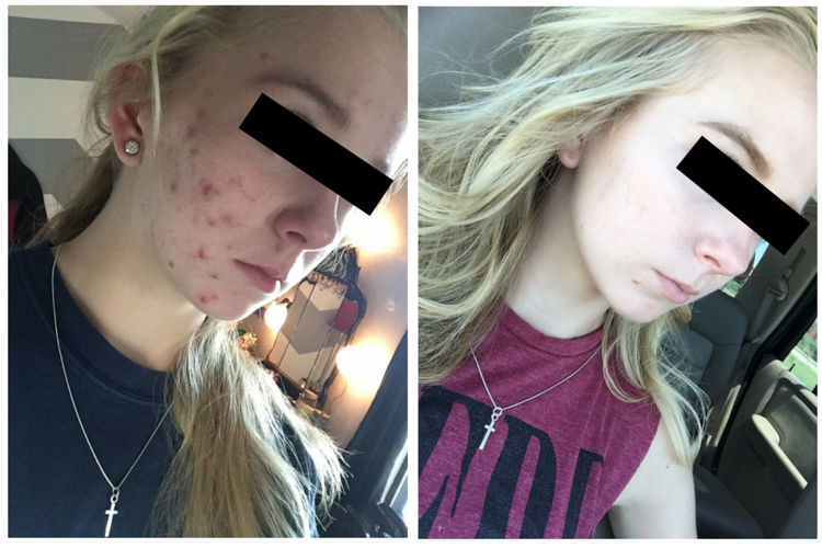 before and after accutane treatment