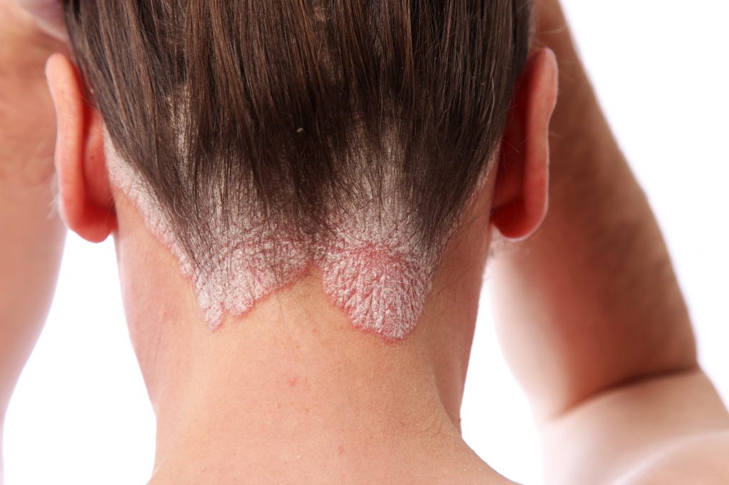 Psoriasis, Psoriasis Treatment Options