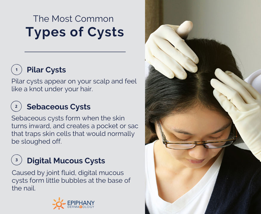 types of cysts