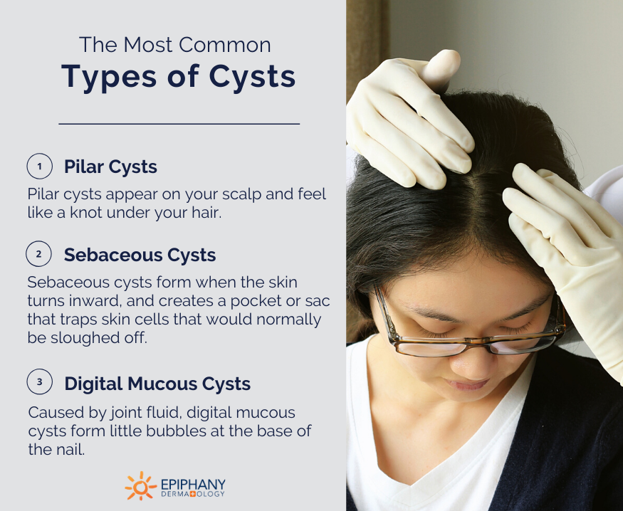 types de kystes