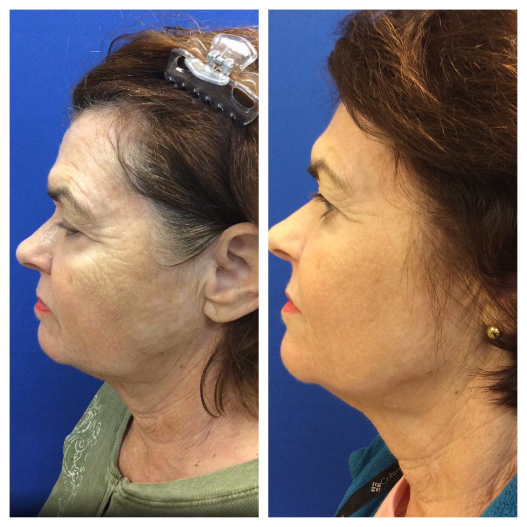 fractional laser before after