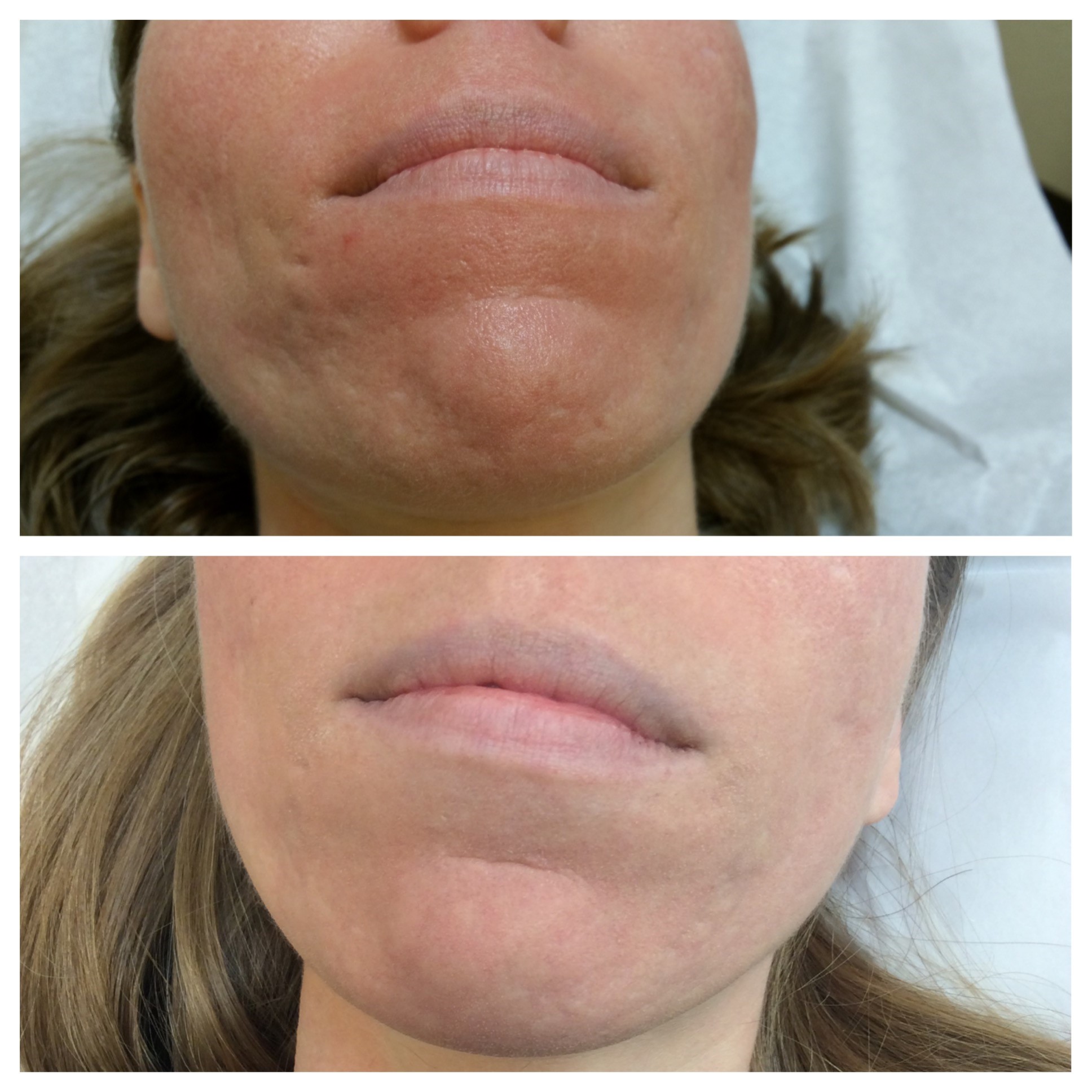 Fractional Laser Scar Treatment Services | Skin Resurfacing