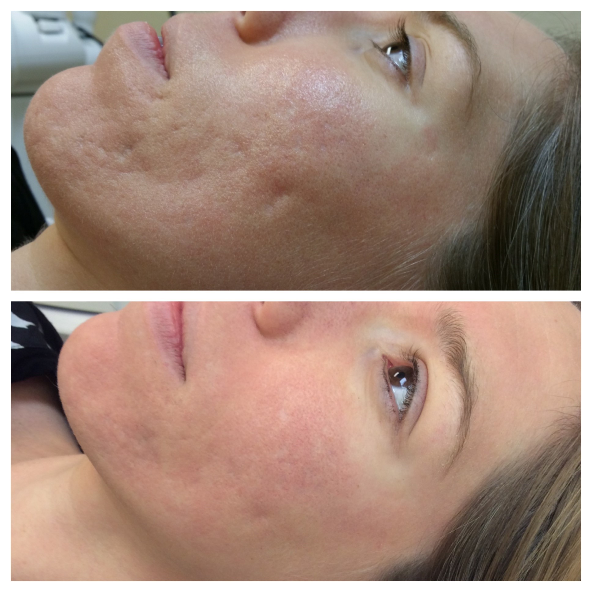 Fractional Laser Scar Treatment Services Skin Resurfacing