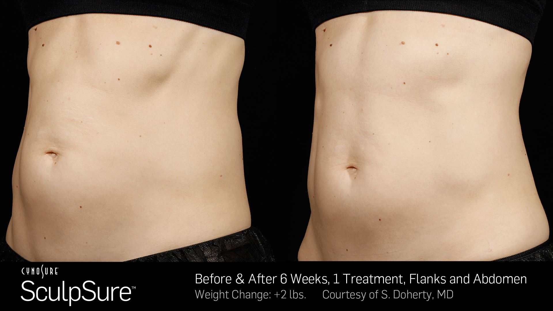 SculpSure Body Contouring Treatment - Dermatology Services In Boulder