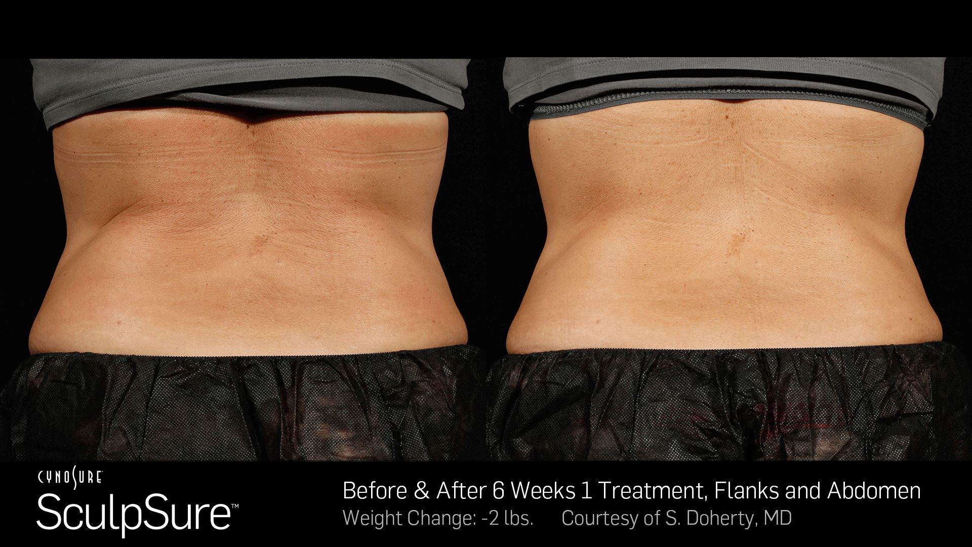 SculpSure Body Contouring Treatment - Dermatology Services In Boulder