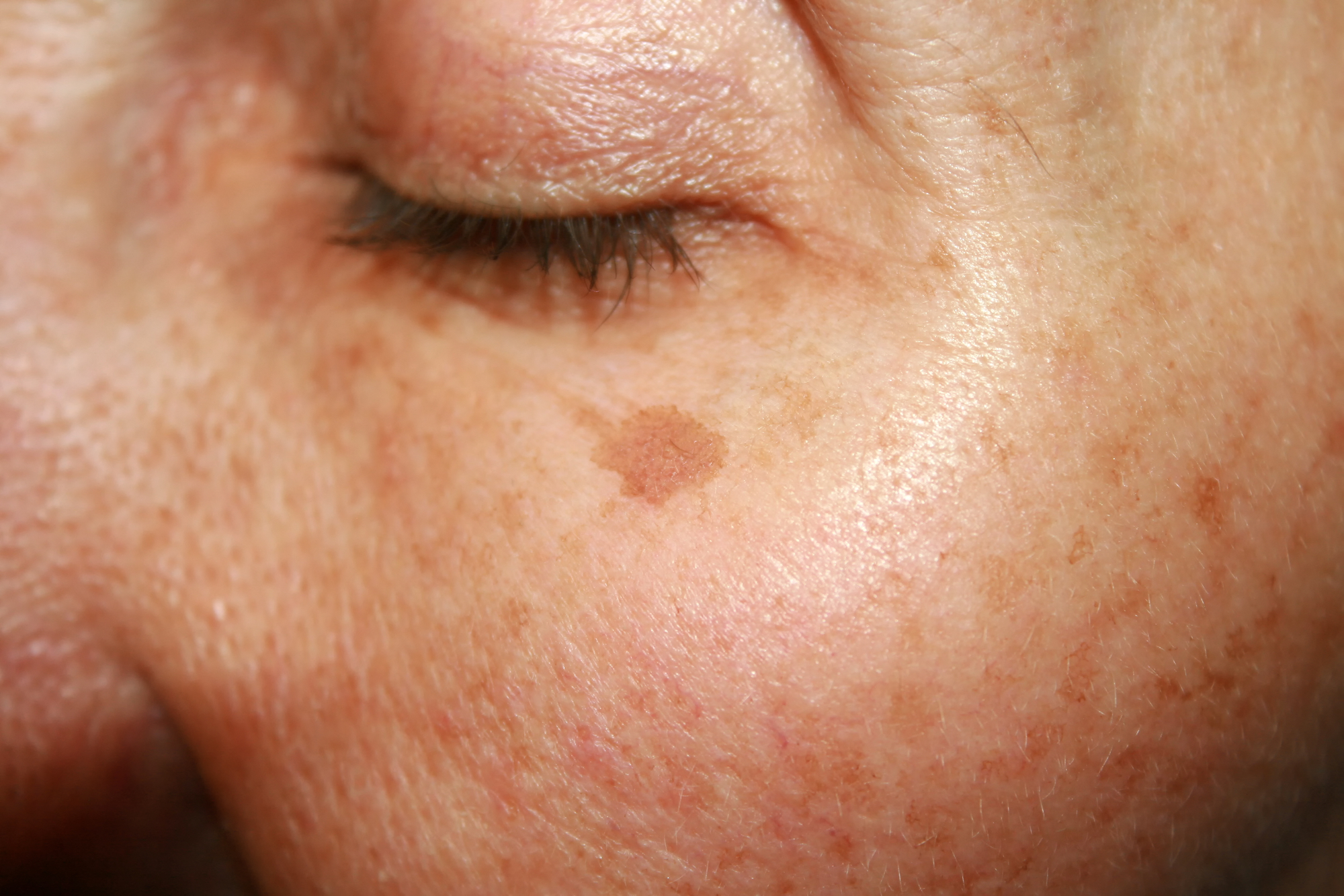 laser treatment for dark spots on the face and body