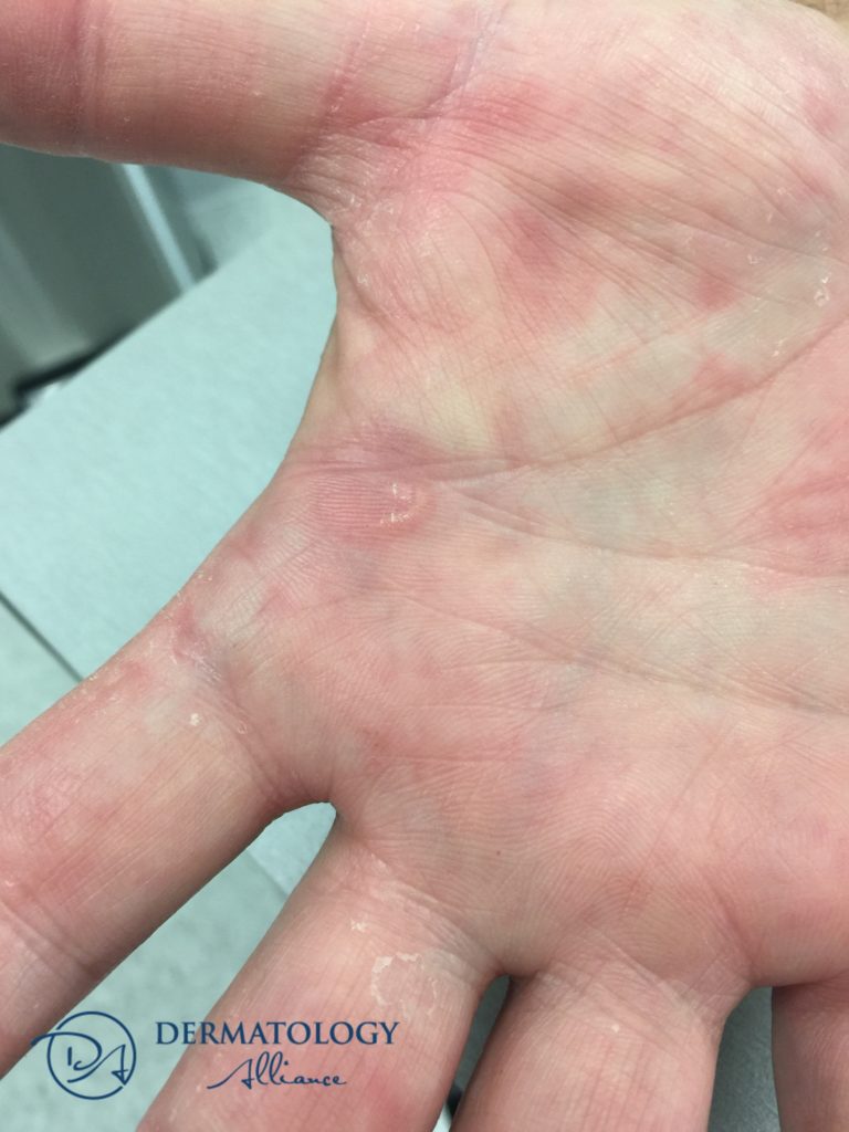 warts on hands liquid nitrogen