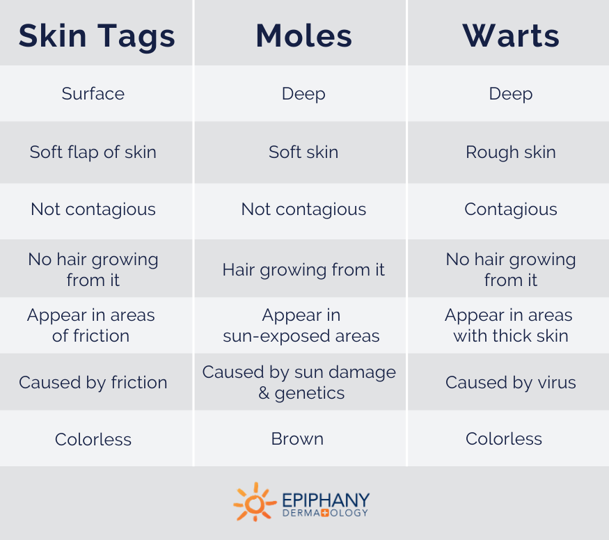 skin tag vs wart vs mole