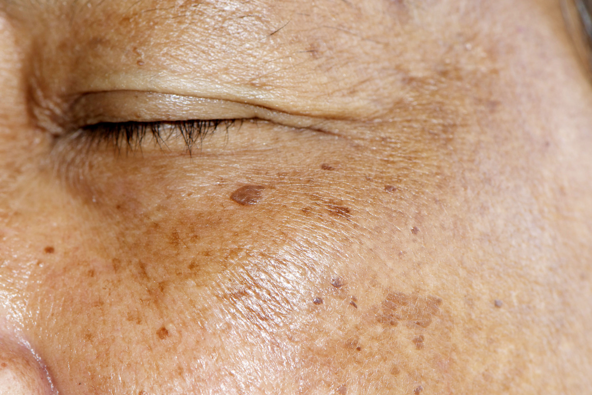 How To Treat Hyperpigmentation Age Spots Melasma