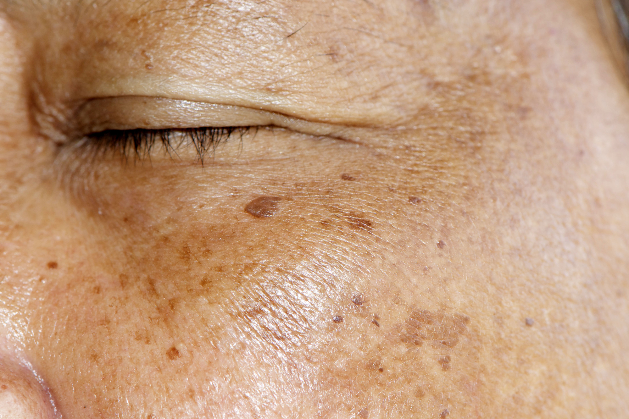 skin pigmentation brown patches