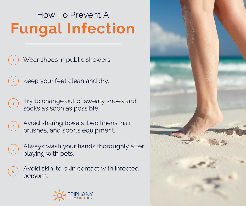 how_to_prevent_common_fungal_infections