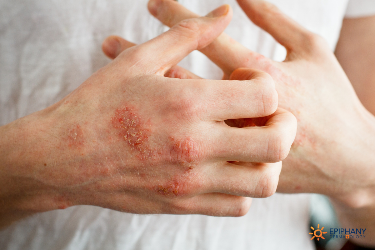 Got heat rash? Here's how to identify and treat the condition