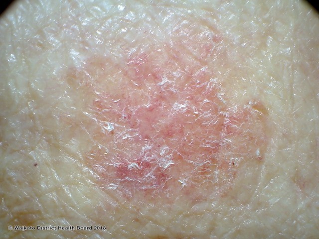 Red Scaly Rash Heres Why You Need A Dermatologist To Diagnose You