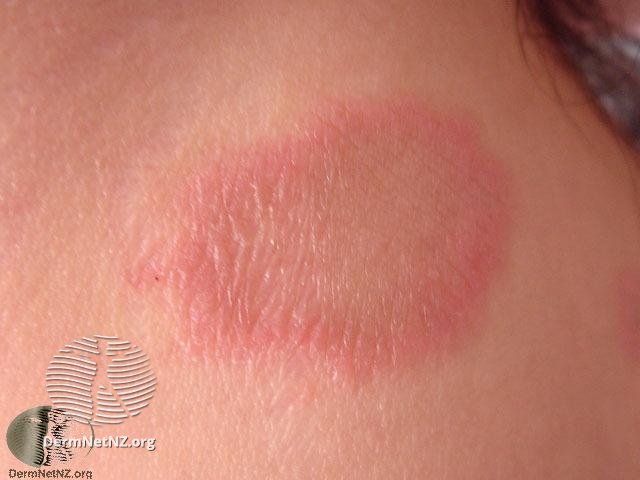 red scaly rash