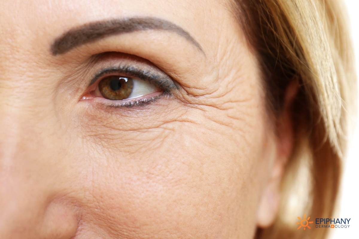 Crow's Feet? 🤜 Here's what you can do about eye wrinkles