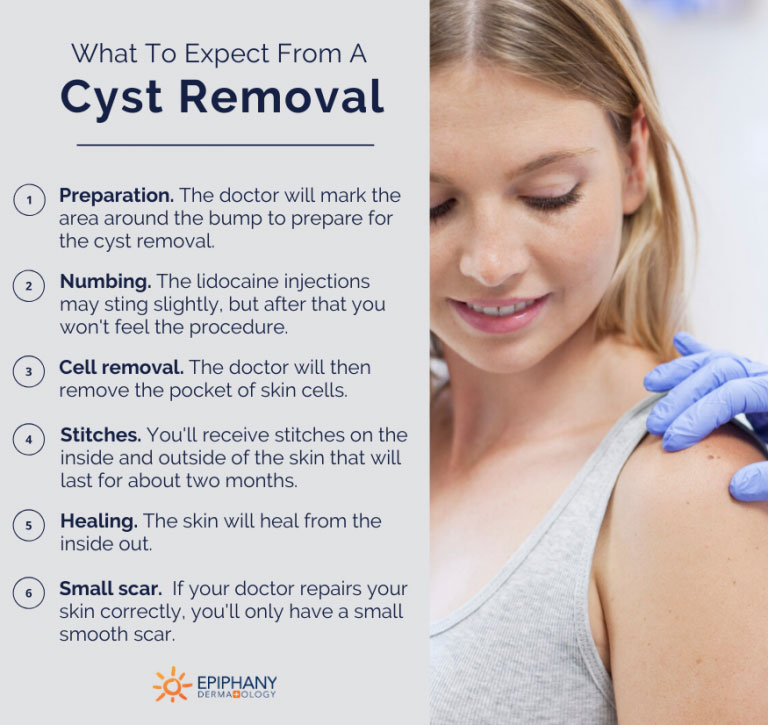 things you can expect from a cyst removal