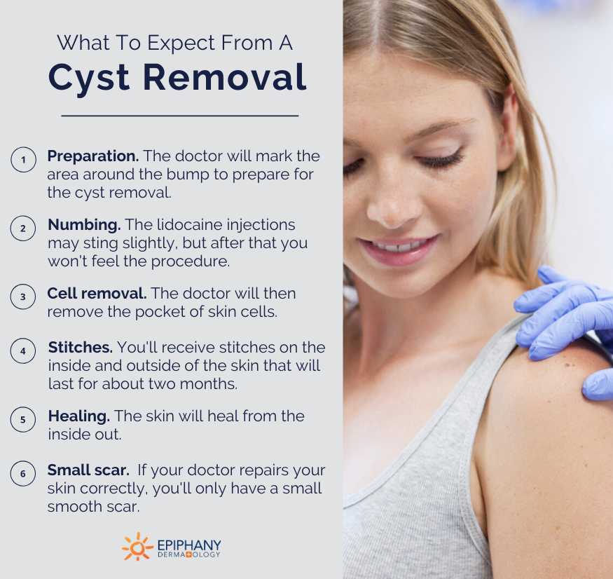what to expect from cyst removal