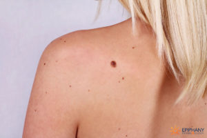 difference between skin tags, moles, and warts