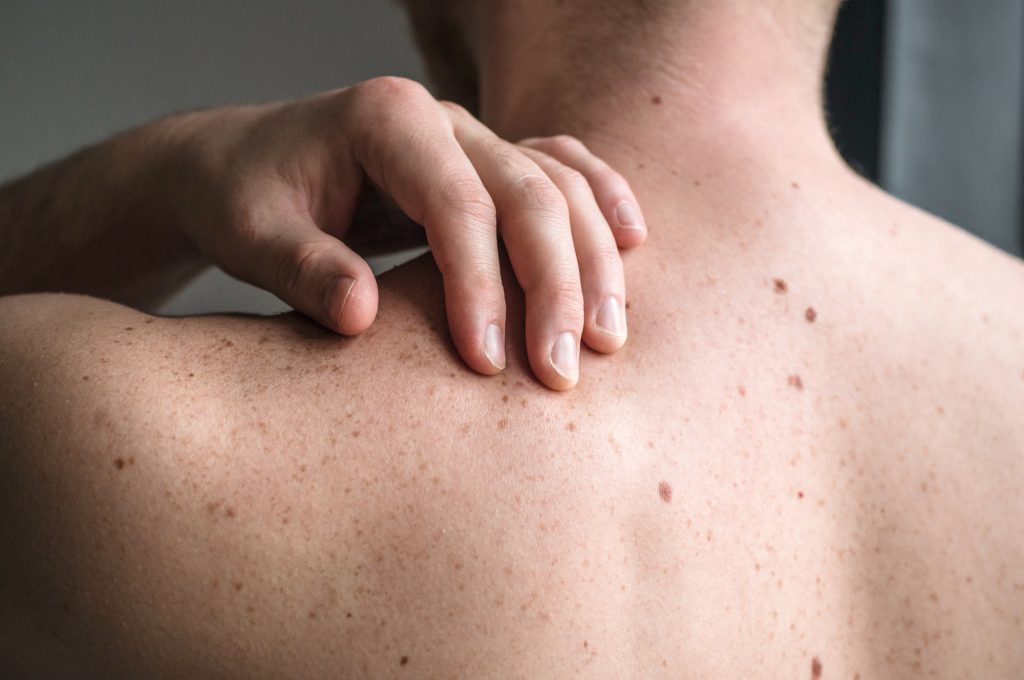 Suspicious Moles Epiphany Dermatology Suspicious Moles Epiphany Dermatology