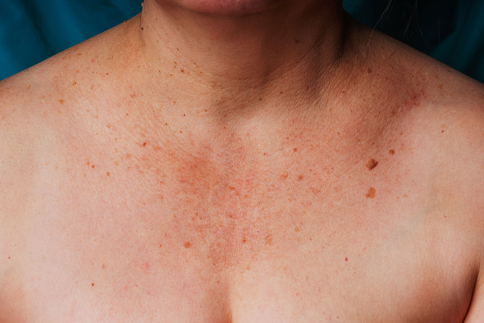 Sunspots, age spots and liver spots: What are they? - Burn and