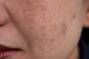 melasma