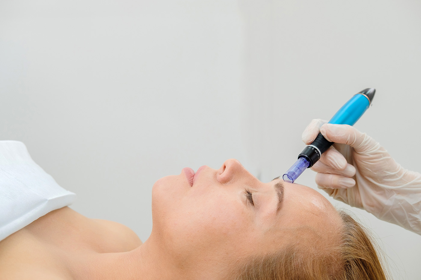 microneedling