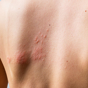 contact dermatitis